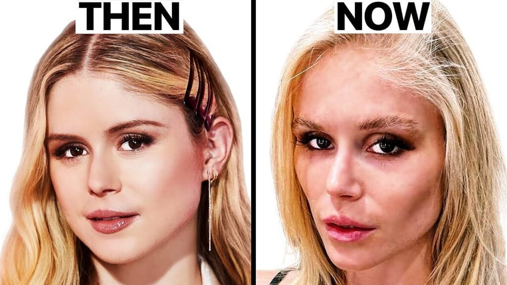 Erin Moriarty Plastic Surgery: :Erin Moriarty (The Boys) NEW FACE | Plastic Surgery Analysis 1 erin moriarty plastic surgery